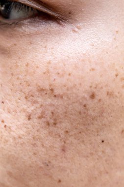 Beyaz arka planda siyah sivilceli kadın, yakın plan.