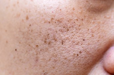 Deri ve sivilce sorunu. Beyaz arka planda insanın yüzünü kapatın..