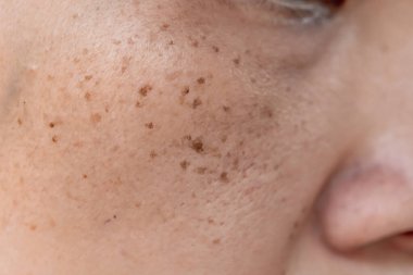 Kahverengi saçlı genç bir kadının teni. Cilt bakımı..