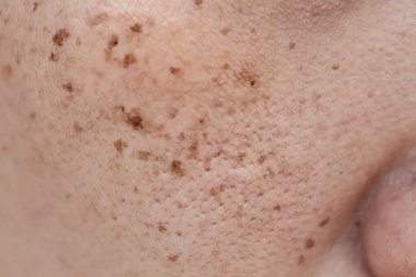 Yüzünde sivilce, derisi ve sorunu olan bir kadının yüzüne yakın çekim. Cilt problemi, cilt bakımı, cilt bakımı