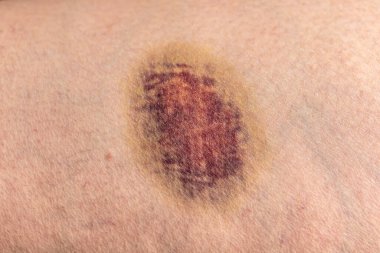 Siyah derili bir adamın derisi, derisinde bir dermatit.