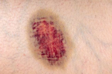 İnsan derisinin derisi insanın derisinde..