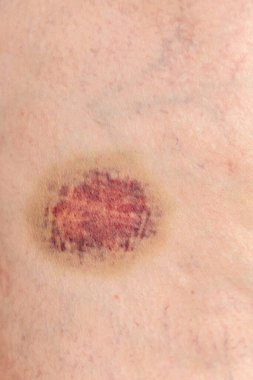 Ameliyattan sonra insan dizi.