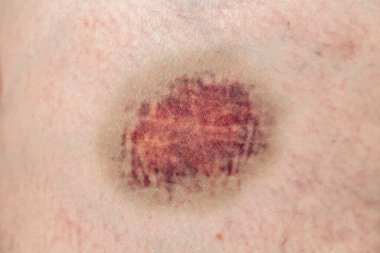 Diz kapağında kırmızı lekeler olan deri, yakın çekim..