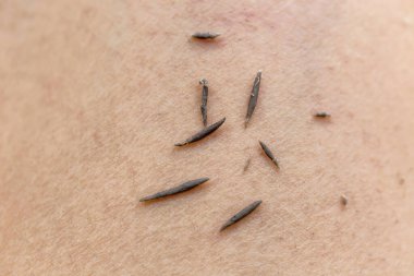 Deriyi iğneyle kapatın.