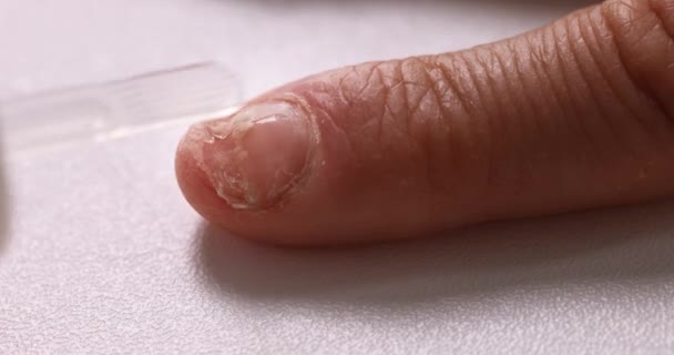 Behandlung Von Nagelpilzinfektionen Amorolfeiner Antimykotika Lack Auf Den Fingernagel Auftragen — Stockvideo