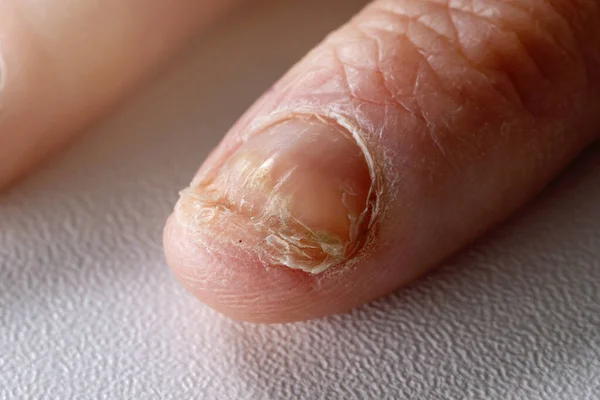 Pilzinfektion Nagelpilz Candida Auf Der Hand Fingernagel — Stockfoto