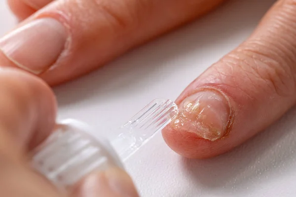 Лечение Грибковой Инфекции Ногтей Нанесение Аморольфинового Противогрибкового Лака Ногти Рук — стоковое фото