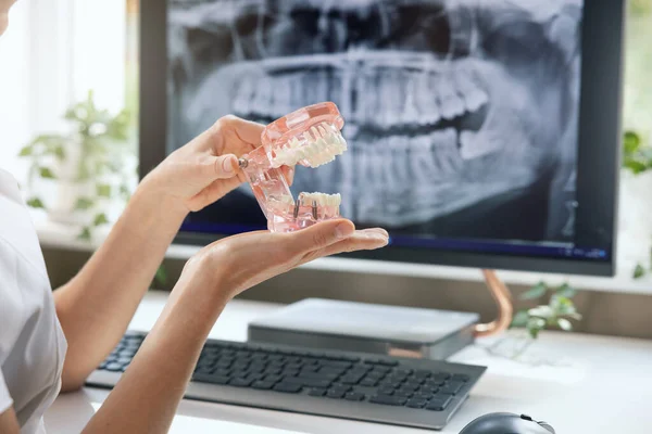 Dentist Implantologist Showing Teeth Model Implant Screw Sample Clinics Office Stockbild