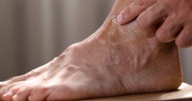 Adam vitiligo beyaz bantlara deri kamuflaj kremi sürüyor. pigment bozukluğu