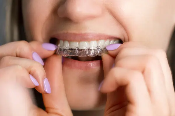 Woman Inserting Transparent Invisible Dental Aligners Teeth Straightening 로열티 프리 스톡 이미지