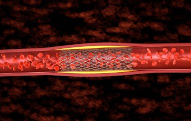 Ven stent ile 3d render balon anjiyoplasti prosedürü