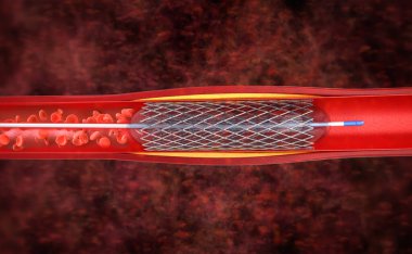 Ven stent ile 3d render balon anjiyoplasti prosedürü