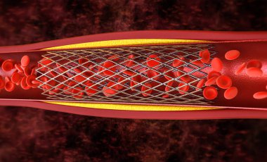 Ven stent ile 3d render balon anjiyoplasti prosedürü