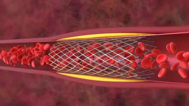 Damarında stent olan balon anjiyoplasti prosedürü
