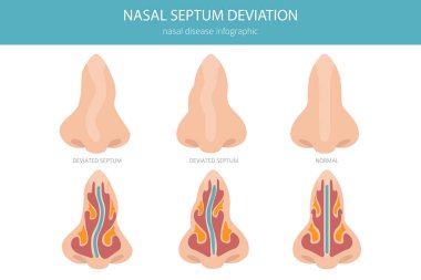 Nose Deviated Septum. Nasal diseases. Medical infographic design. Vector illustration clipart