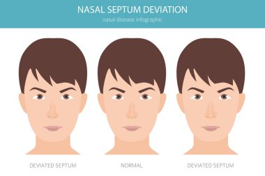 Nose Deviated Septum. Nasal diseases. Medical infographic design. Vector illustration clipart