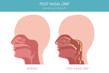Burun akışından sonra. Burun hastalıkları. Tıbbi bilgi tasarımı. Vektör illüstrasyonu