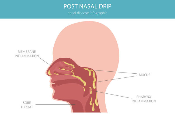 После носовой капельницы. Носовые заболевания. Медицинский инфографический дизайн. Векторная иллюстрация