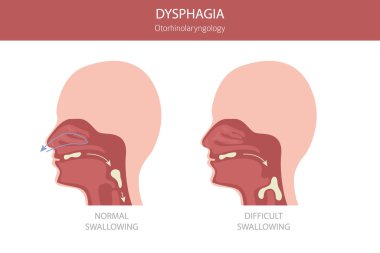 Oral disfaji hastalıkları. Otorhinolarengoloji. Yutmakta zorlanıyorum. Tıbbi bilgi tasarımı. Vektör illüstrasyonu