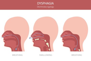 Oral disfaji hastalıkları. Otorhinolarengoloji. Yutmakta zorlanıyorum. Tıbbi bilgi tasarımı. Vektör illüstrasyonu