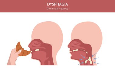 Oral disfaji hastalıkları. Otorhinolarengoloji. Yutmakta zorlanıyorum. Tıbbi bilgi tasarımı. Vektör illüstrasyonu