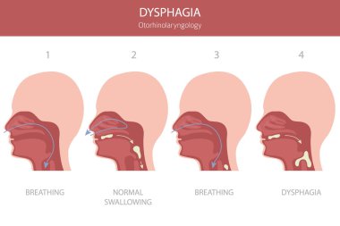 Oral disfaji hastalıkları. Otorhinolarengoloji. Yutmakta zorlanıyorum. Tıbbi bilgi tasarımı. Vektör illüstrasyonu