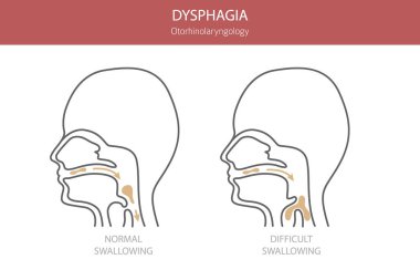 Oral disfaji hastalıkları. Otorhinolarengoloji. Yutmakta zorlanıyorum. Tıbbi bilgi tasarımı. Vektör illüstrasyonu