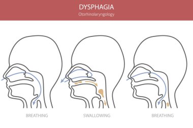 Oral disfaji hastalıkları. Otorhinolarengoloji. Yutmakta zorlanıyorum. Tıbbi bilgi tasarımı. Vektör illüstrasyonu