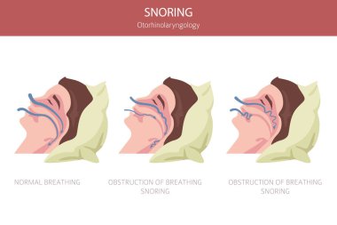 Horlama hastalıkları. Engelleyici uyku apnesi. Uyku kaynaklı solunum bozukluğu. Tıbbi bilgi tasarımı. Vektör illüstrasyonu