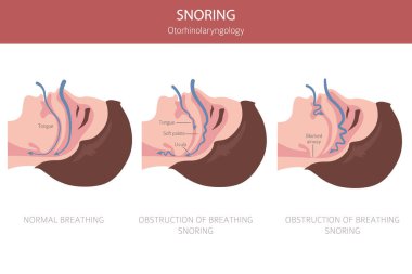 Horlama hastalıkları. Engelleyici uyku apnesi. Uyku kaynaklı solunum bozukluğu. Tıbbi bilgi tasarımı. Vektör illüstrasyonu