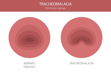 Trakeomalasya hastalığı. Pulmonoloji, otolaringoloji. Tıbbi bilgi tasarımı. Vektör illüstrasyonu