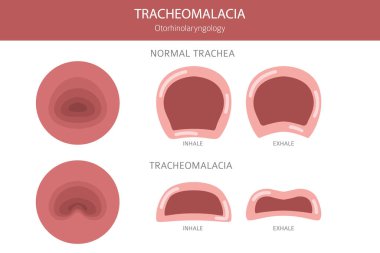 Trakeomalasya hastalığı. Pulmonoloji, otolaringoloji. Tıbbi bilgi tasarımı. Vektör illüstrasyonu