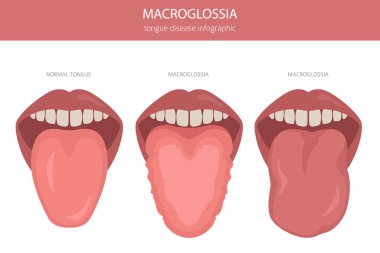 Macroglossia dil hastalığı. Ağız ilacı. Tıbbi bilgi tasarımı. Vektör illüstrasyonu