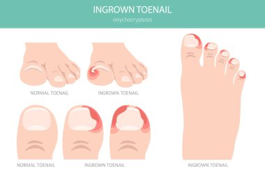 Tırnak büyümesi ya da onyechocryptosis, tırnak ağrısı, kızarıklık ve deri içinde şişmeye neden olan bir tırnak rahatsızlığıdır. Tıbbî bilgiler. Vektör illüstrasyonu