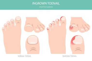 Tırnak büyümesi ya da onyechocryptosis, tırnak ağrısı, kızarıklık ve deri içinde şişmeye neden olan bir tırnak rahatsızlığıdır. Tıbbî bilgiler. Vektör illüstrasyonu