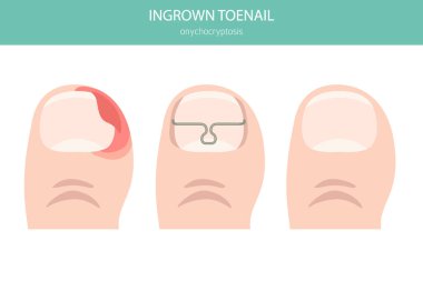 Tırnak büyümesi ya da onyechocryptosis, tırnak ağrısı, kızarıklık ve deri içinde şişmeye neden olan bir tırnak rahatsızlığıdır. Tıbbî bilgiler. Vektör illüstrasyonu
