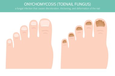 Onikomikozisin tıbbi temsili yaygın bir mantar ayak tırnağı enfeksiyonudur. Ayrıntılı bilgi, tırnak rengi değişimini, kalınlaşmayı ve deformasyonu gösteriyor. Dermatoloji, ayak hastalıkları, sağlık eğitimi ve tıbbi tasarım projeleri için kullanışlı
