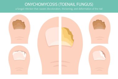 Onikomikozisin tıbbi temsili yaygın bir mantar ayak tırnağı enfeksiyonudur. Ayrıntılı bilgi, tırnak rengi değişimini, kalınlaşmayı ve deformasyonu gösteriyor. Dermatoloji, ayak hastalıkları, sağlık eğitimi ve tıbbi tasarım projeleri için kullanışlı