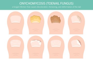 Onikomikozisin tıbbi temsili yaygın bir mantar ayak tırnağı enfeksiyonudur. Ayrıntılı bilgi, tırnak rengi değişimini, kalınlaşmayı ve deformasyonu gösteriyor. Dermatoloji, ayak hastalıkları, sağlık eğitimi ve tıbbi tasarım projeleri için kullanışlı