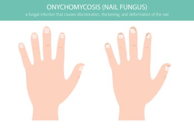 Onikomikozisin tıbbi temsili yaygın bir mantar ayak tırnağı enfeksiyonudur. Ayrıntılı bilgi, tırnak rengi değişimini, kalınlaşmayı ve deformasyonu gösteriyor. Dermatoloji, ayak hastalıkları, sağlık eğitimi ve tıbbi tasarım projeleri için kullanışlı