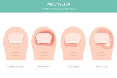 Paronychia, tırnak kıvrımında kızarıklığa, şişliğe ve ağrıya neden olan bir enfeksiyondur. Genellikle bakteri, travma ya da rutubete maruz kalmayla bağlantılı. Tıbbi bilgi tasarımı. Vektör illüstrasyonu