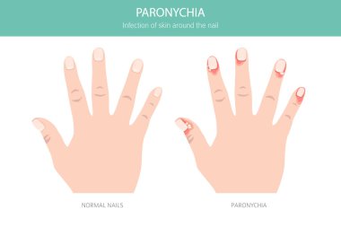 Paronychia, tırnak kıvrımında kızarıklığa, şişliğe ve ağrıya neden olan bir enfeksiyondur. Genellikle bakteri, travma ya da rutubete maruz kalmayla bağlantılı. Tıbbi bilgi tasarımı. Vektör illüstrasyonu