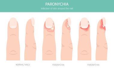 Paronychia, tırnak kıvrımında kızarıklığa, şişliğe ve ağrıya neden olan bir enfeksiyondur. Genellikle bakteri, travma ya da rutubete maruz kalmayla bağlantılı. Tıbbi bilgi tasarımı. Vektör illüstrasyonu