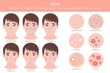 Sivilce hastalığı. Deri hastalıkları. Tıbbi bilgi tasarımı. Vektör illüstrasyonu