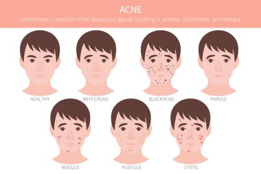 Sivilce hastalığı. Deri hastalıkları. Tıbbi bilgi tasarımı. Vektör illüstrasyonu