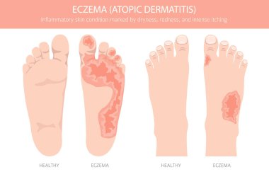 Egzama. Deri iltihabı. Deri hastalıkları. Tıbbi bilgi tasarımı. Vektör illüstrasyonu