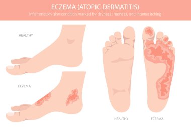 Egzama. Deri iltihabı. Deri hastalıkları. Tıbbi bilgi tasarımı. Vektör illüstrasyonu