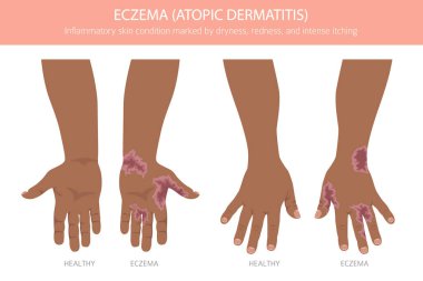 Egzama. Deri iltihabı. Deri hastalıkları. Tıbbi bilgi tasarımı. Vektör illüstrasyonu