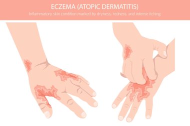 Egzama. Deri iltihabı. Deri hastalıkları. Tıbbi bilgi tasarımı. Vektör illüstrasyonu